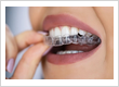 Clear Aligners Treatment