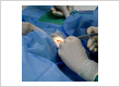 Cataract surgery