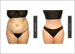 Tummy Tuck NJ by Millennial Plastic Surgery