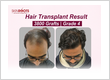 hair transplant result