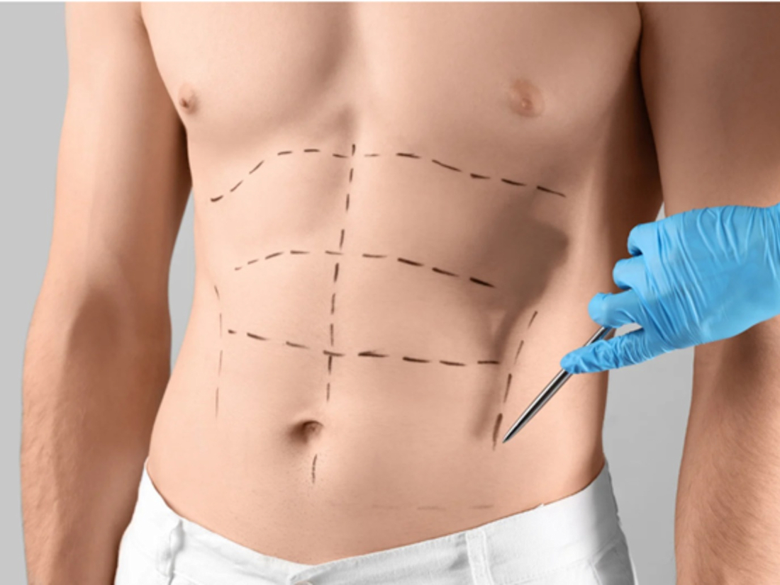 Abdominoplasty in Islamabad: Procedure, Recovery, and Results