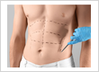 Abdominoplasty in Islamabad: Procedure, Recovery, ...