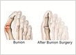 Hammertoe Surgery Center
