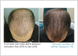 rapaport-hair-restoration-before-and-after-9-1