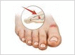 Hammertoe Surgery Center