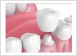 All Ceramic Crowns