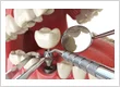 What Really Happens to Your Extraction Socket During Immediate Implant Placement?