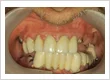 Implant 3 before