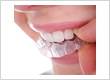 invisible braces - no gap dentists - sydney