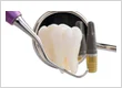 Why Implant Positioning Is Critical for Functional Success