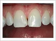Dermal Fillers West Palm Beach: Professional Facial Filler Treatments in Florida