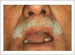 Implant 1 before