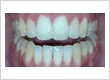 open bite teeth correction