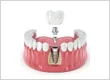 Restore Your Smile with Dental Implants