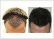 Rahal Hair Transplant