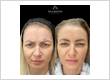 best botox treatment