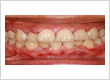 Dental Crowns Brooklyn