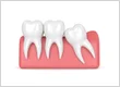 Signs Your Wisdom Tooth Extraction Site Is Healing Properly