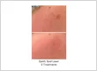 DYL Spot Laser Treatment Calgary