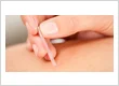 imgi 22 acupuncture hero.jpg