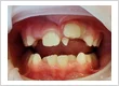 Abnormal Tooth Eruption