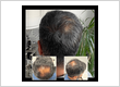 Hair transplantation clinic