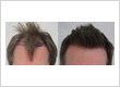 Rahal Hair Transplant