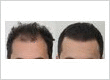 Rahal Hair Transplant