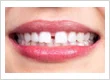 Gap teeth