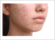 Hormonal acne