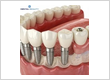 Dental Implant Periodontist