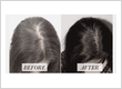 PRP for Hairloss