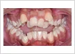 Overcrowded Teeth