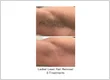 Laser Hair Removal For Womens Calgary