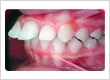 proclined teeth