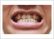 crossbite teeth