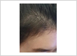 Male Pattern Hair Loss