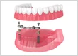 overdentures iconMD