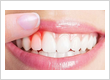 Dental Crowns Brooklyn