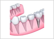All On 4 implant provider