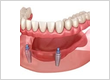 permanent teeth implant treatment