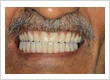 Implant 2 after