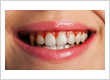 Dental Crowns Brooklyn