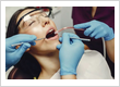 tooth extraction