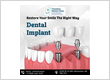 Restore Yout Smile Dental Implants