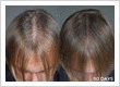 Hair Loss Treatment