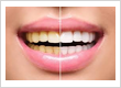 Teeth Whitening San Diego