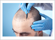 Hair Transplants