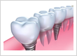 dental implants - no gap dentists - sydney
