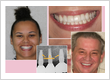 Cosmetic Dentist, Dental Implants provider